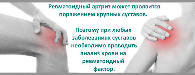 ревматоидный артрит