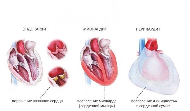 болезнь пневмония - осложнения для сердца