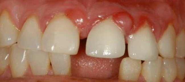 диагноз гранулёма зубов