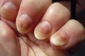 Болезни ногтей, при которых изменяется их цвет.