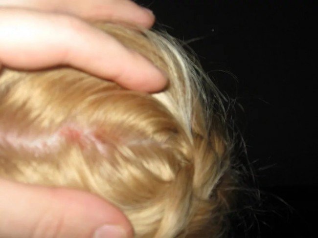 Как восстановить кожу головы и не допустить выпадения волос