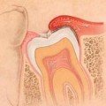 воспаление десны при неполном прорезывании зуба мудрости