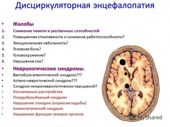 Энцефалопатия головного мозга: симптомы