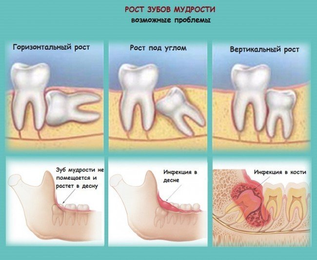 Проблемы при прорезывании зубов мудрости