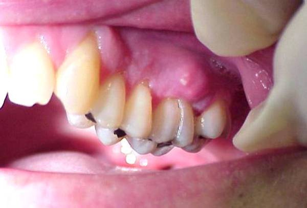 Как распознать гнойный абсцесс зуба?