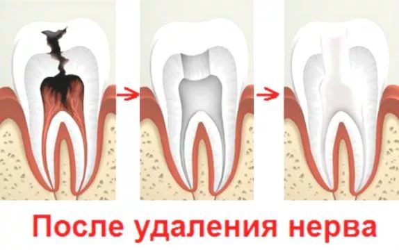 зуб без нерва