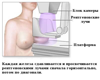исследование на маммографе