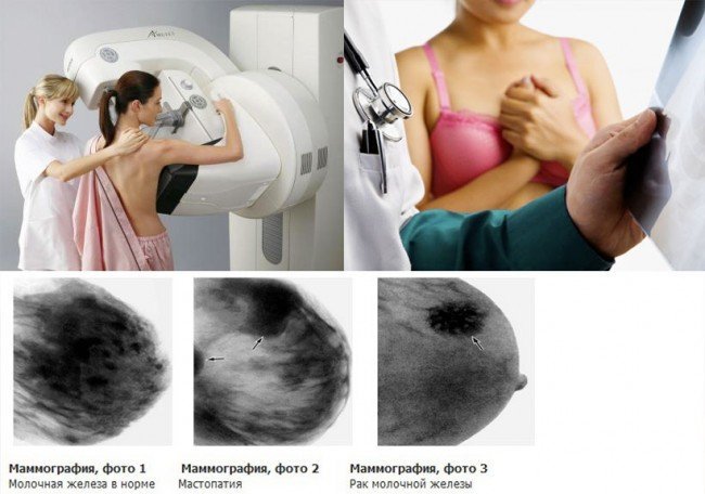 маммография груди