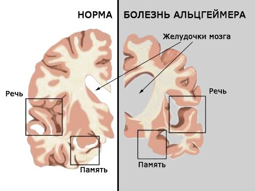 Изменения в мозге