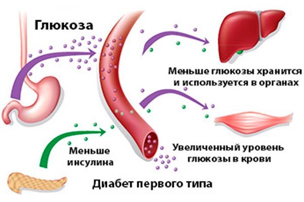 диабет первого типа