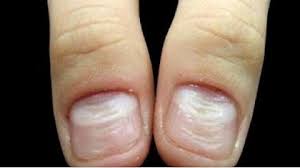 Деформация ногтей, по которым "читают" заболевание.