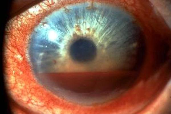 повреждение глаза могут спровоцировать болезнь
