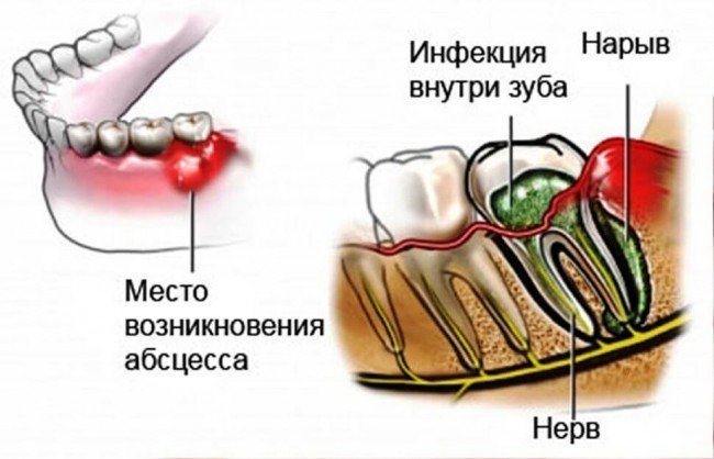 инфекция в зубном корне