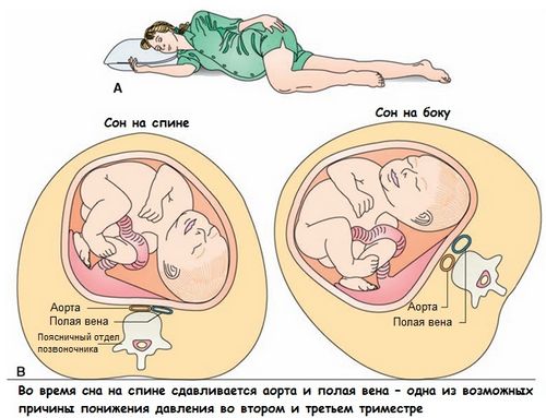 Пережимается вена, если спать на спине, сон беременной