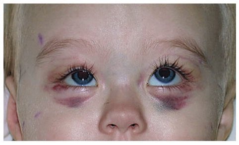 Болезнь Виллебранда: синяки под глазами