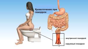 кровотечение при геморрое