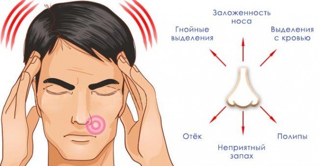 Синдром Пустого Носа