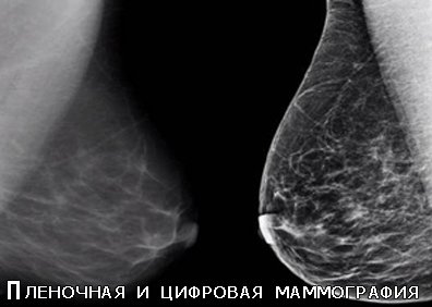 Рентгеновский снимок груди