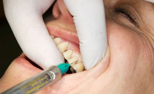 Применение анестезии, во время лечения зубов.