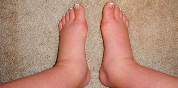 аллергический отек ног