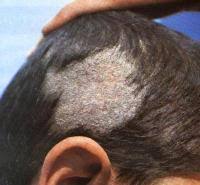 Что такое микроспория волосистой кожи? Последствия заболевания