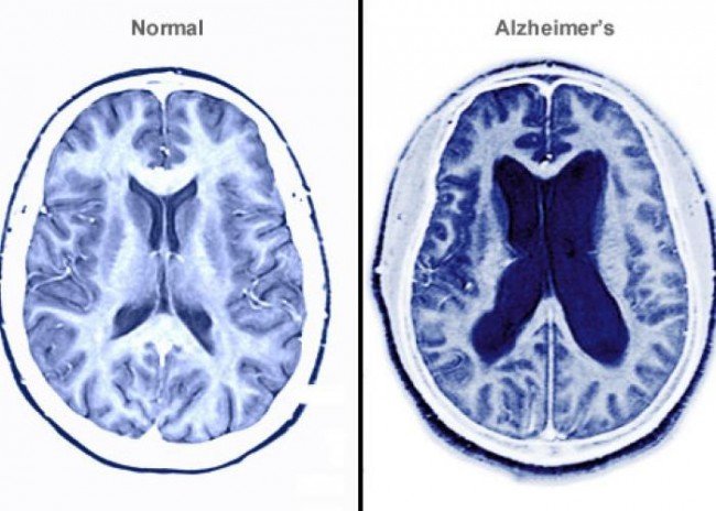 диагноз - тяжелая стадия Альцгеймера
