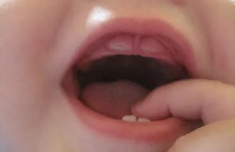 прорезывание зубов в раннем возрасте
