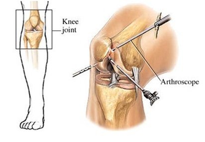 Суть артроскопии коленного сустава
