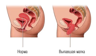 Опущение матки