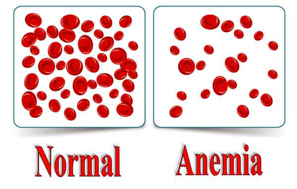 Первые признаки анемии: как определить без анализов?