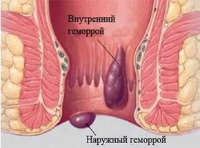 геморрой: внутренний и наружный