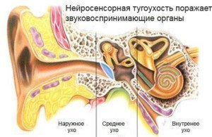 нейросенсорная тугоухость - причины