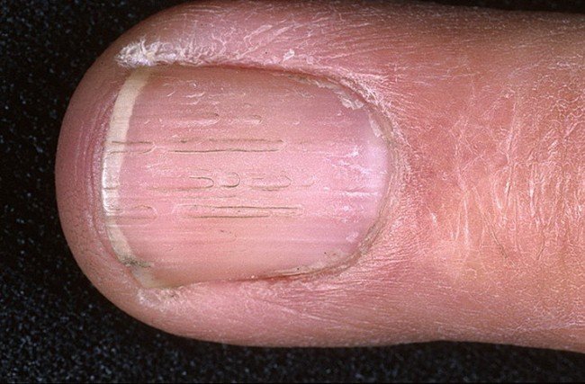 бороздки вдоль ногтя, лечение